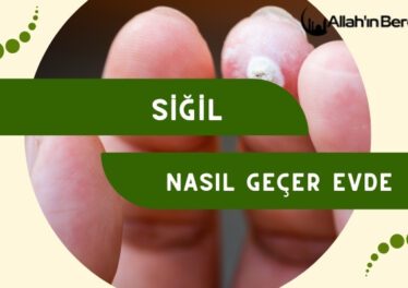 Siğil Nasıl Geçer Evde