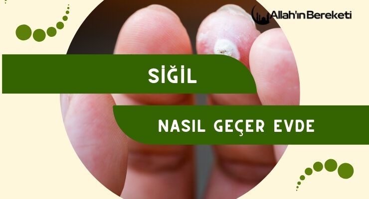 Siğil Nasıl Geçer Evde